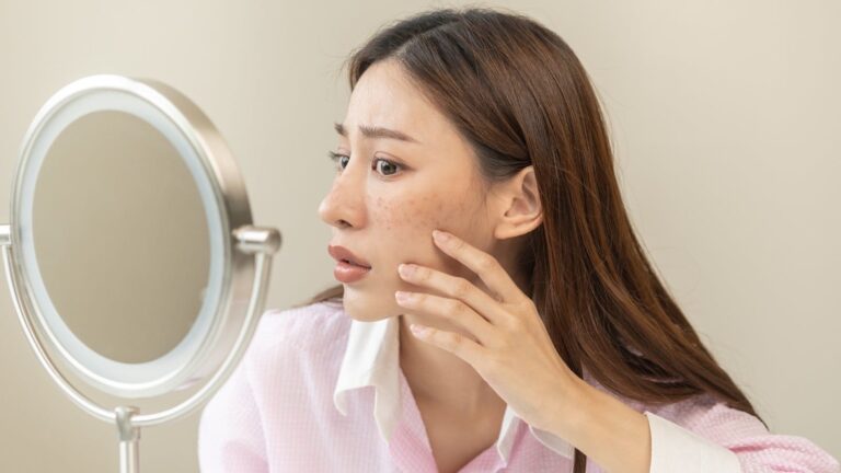 Reduce acne scars with these 5 home remedies