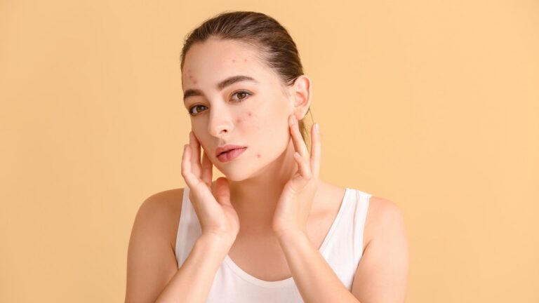 Say goodbye to hormonal acne with quick and effective tips
