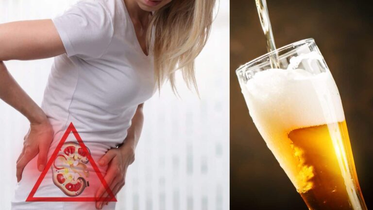 Beer for kidney stones: Is it safe or not?