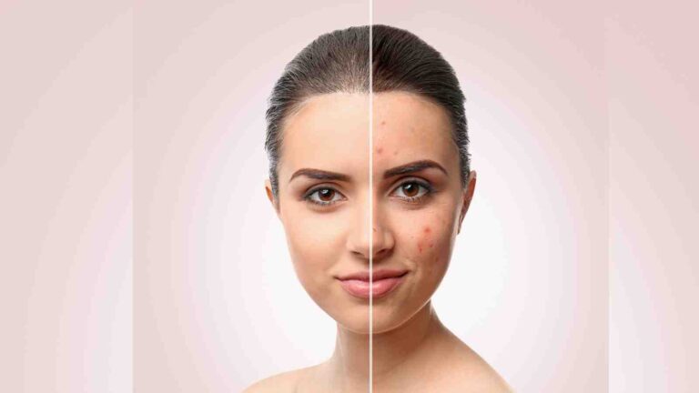DIY skincare: 5 homemade face packs for acne-prone skin