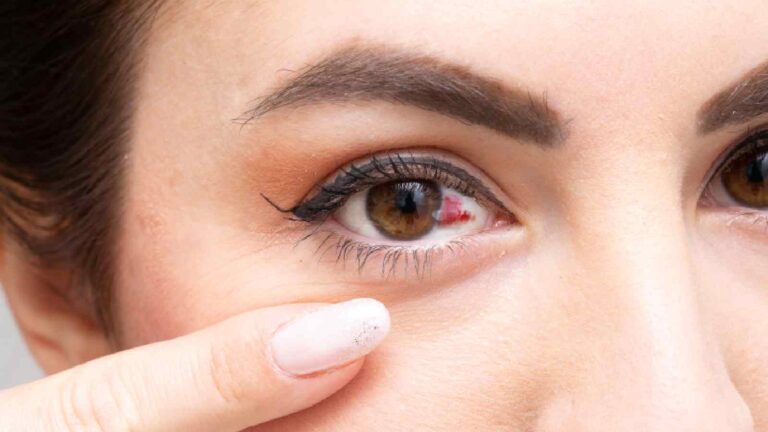Subconjunctival hemorrhage: What a broken blood vessel in eye means