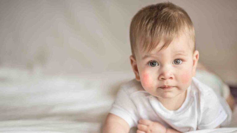 Baby acne vs eczema: Know the difference