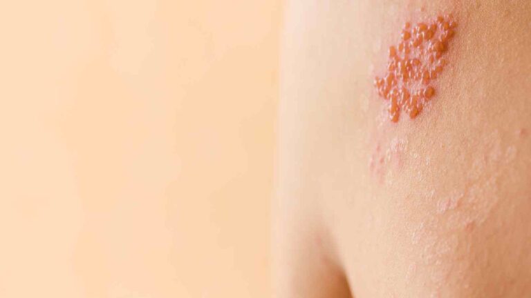 Shingles: Know myths vs facts about this viral infection