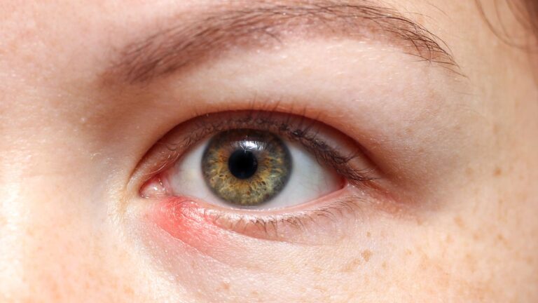 What causes a stye, risks and how can you treat and prevent