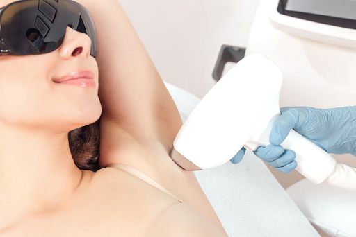 laser hair removal in Blackpool